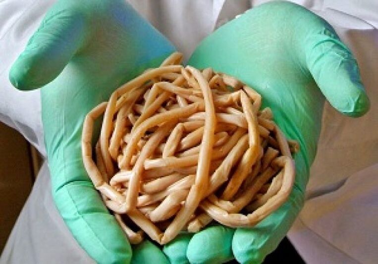 Parasitaire wormen uit het menselijk lichaam