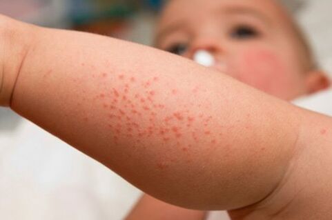 Allergie bij een kind als symptoom van de aanwezigheid van wormen