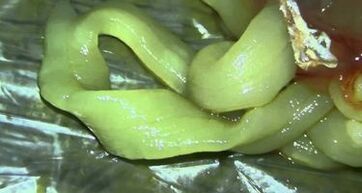 worm uit het menselijk lichaam